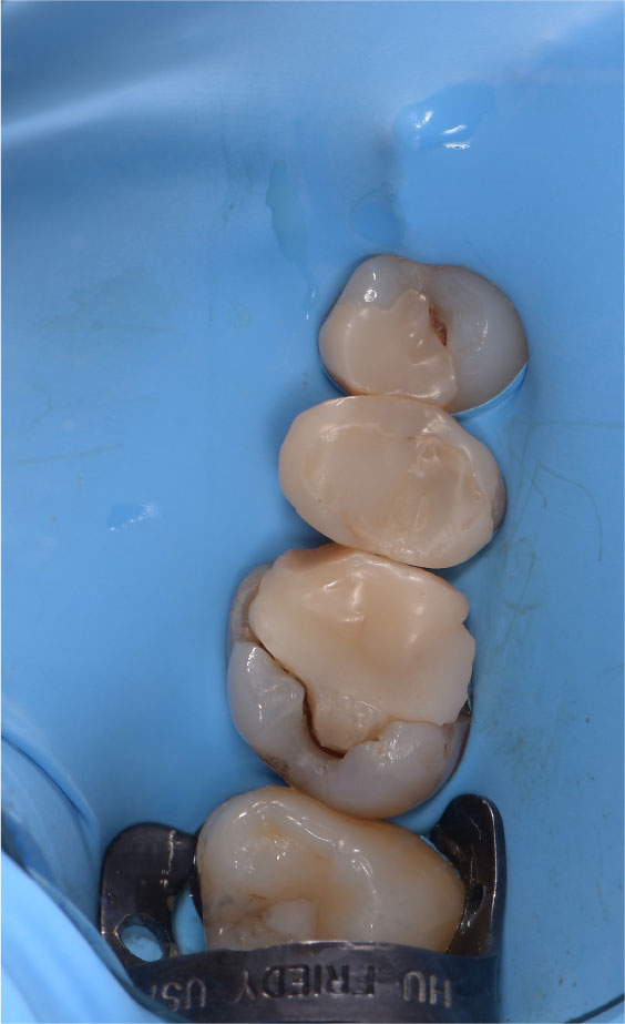Surgical Field Isolation Through Rubber Dam to Prevent COVID-19 Exposure During Tooth Extraction: Case Report
