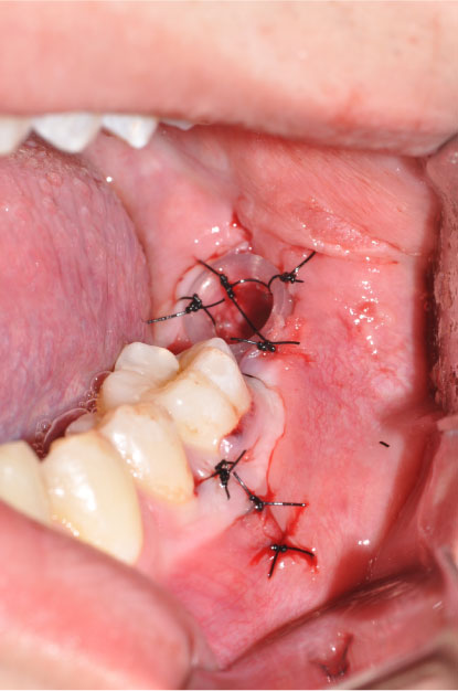 Multimodal Protocol for the Treatment of Odontogenic Keratocysts