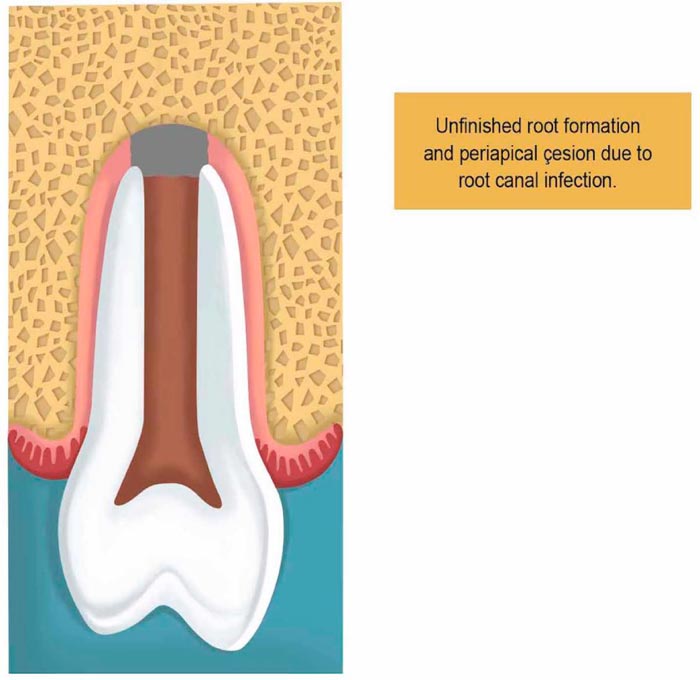 Mechanisms Involved in Apice Closure of Pulpless Teeth – Literature Review