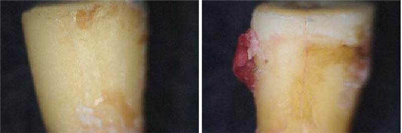 Performance of Bioceramic-based Root Filling Material with Artifact Reduction Properties in the Detection of Vertical Root Fractures Using Cone-beam Computed Tomography