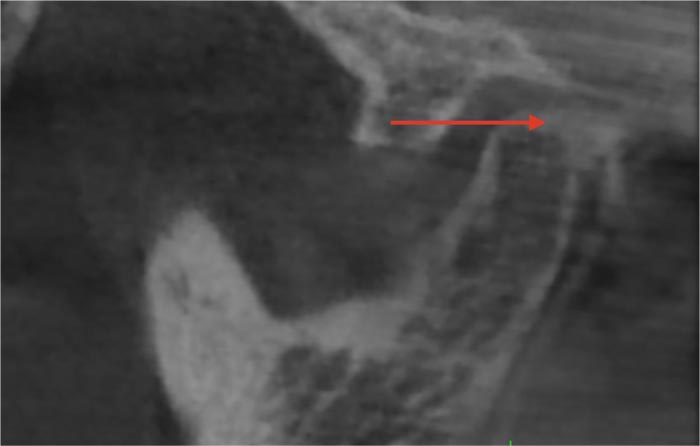 Degenerative Changes in the Temporomandibular Joint in Elderly Patients with Posterior Edentulous Maxilla and Mandibula According to Cone-Beam Computed Tomography Data.