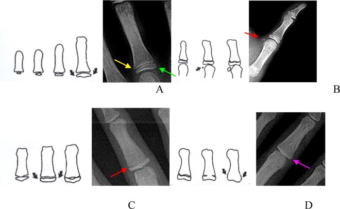 Determination of Pubertal Growth Plot Using Hand-wrist and Cervical Vertebrae Maturation Indices, Dental Calcification, Peak Height Velocity, and Menarche
