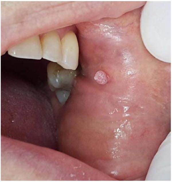 Efficacy of Diode Laser in Treating Oral Papilloma: A Case Report