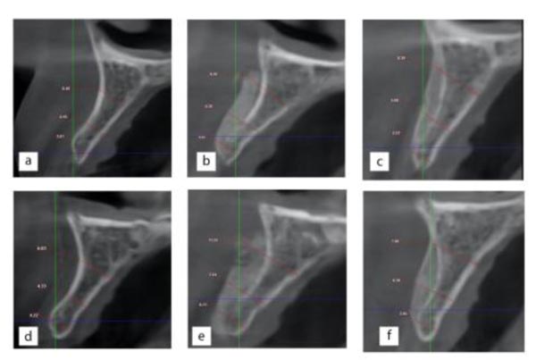 Mineralized Plasmatic Matrix for Horizontal Ridge Augmentation in Anterior Maxilla with and without a Covering Collagen Membrane