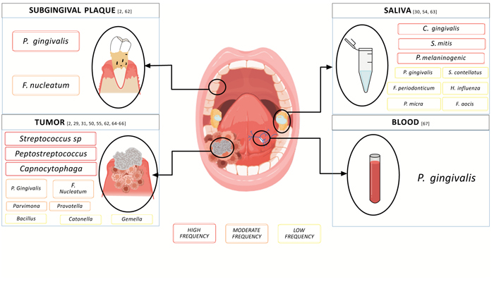 The Role of Periodontopathogens and Oral Microbiome in the Progression of Oral Cancer. A Review