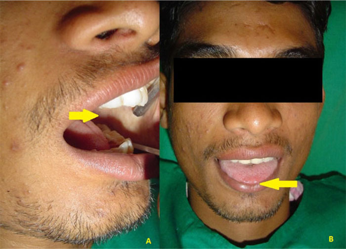 Quality of Life in Oral Submucous Fibrosis- A Case Report with a Literature Review