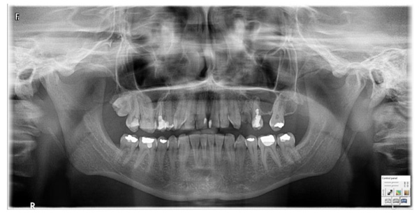 Oral Surgical and Haematological Management in a Female Patient with Turner Syndrome and Moderate Haemophilia A: Clinical Observation and Case Report