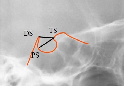 Sella Turcica Bridging and its Association with Dental Anomalies