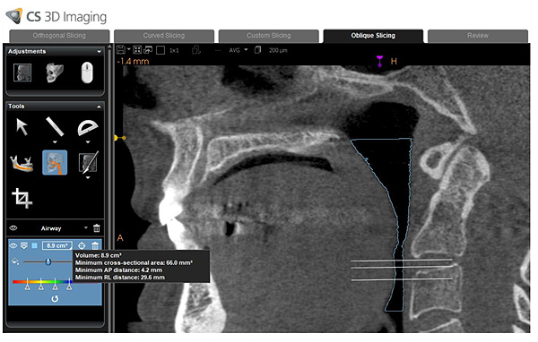 Usefulness of Hard Palate Measurements in Predicting Airway Dimensions in Patients Referred for Cone Beam CT
