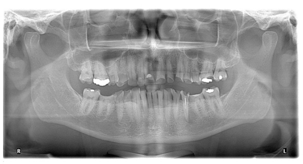 The Restoration of Severe Generalized Dental Erosive Wear using Direct Composite: A Case Report