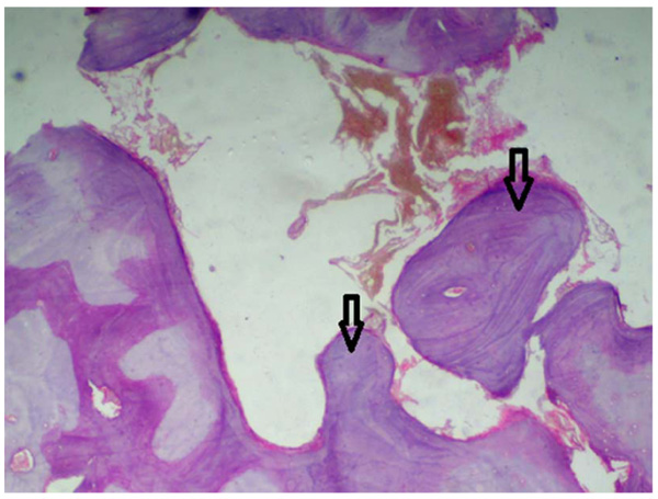Comparison of Biocompatibility of Experimental Tricalcium Phosphate Cement  Biodentin and Mineral Trioxide Aggregate used for Furcation Perforation Repair ( study)