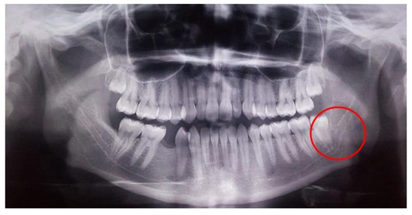 Conduction of Third Molar Extraction with the Presence of Retromolar Canal: A Case Report