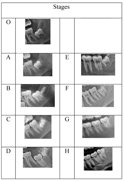 Sensitivity and Specificity of Mandibular Third Molar Calcification at Chronological Age and Hand Wrist Maturation Stage to Discriminate Between Female and Male at Pubertal Growth Period