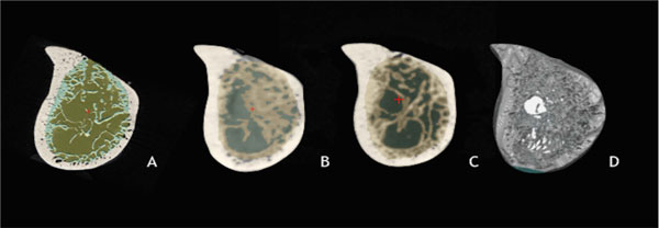 Assessment of Trabecular Bone During Dental Implant Planning using Cone-beam Computed Tomography with High-resolution Parameters
