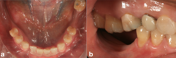 Rehabilitation of Atrophic Posterior Mandible with Vertical Ridge Augmentation with Resorbable Membrane: Case Report with 3-Year Follow-up