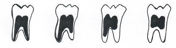 Chronological Age Assessment Based on the Root Pulp Visibility in Lower Third Molars in a Group of Thai Population: Panoramic Radiographic Study