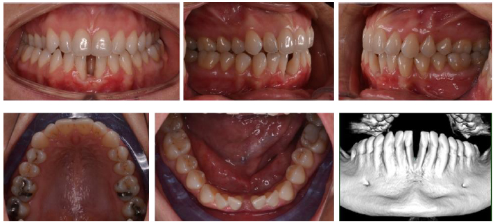 Predictability of Root Movements Using Virtual Root Setup in a Patient With Periodontal Disease Treated With Clear Aligners