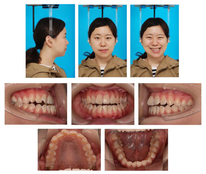 Surgical Orthodontic Treatment for Skeletal Class I with Facial Asymmetry and Occlusal Cant: A Case Report