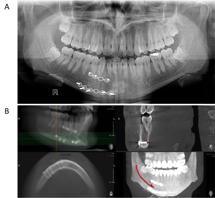 Is Dental Panoramic Radiography Reliable to Assess Position of Bicortical Fixation Screws in Mandibular Fractures? Case Report