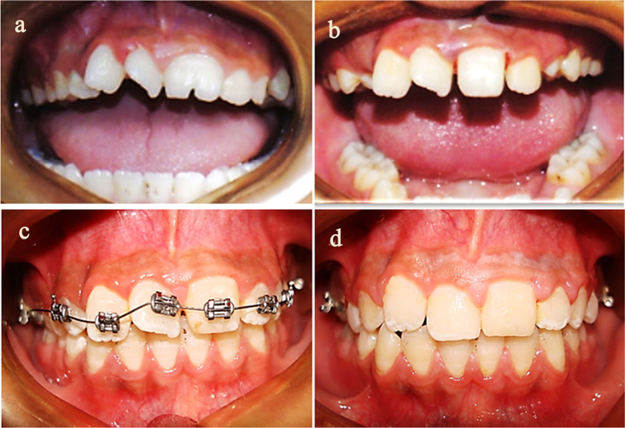 Management of the Two Dental Developmental Anomalies in Two Maxillary Incisors for Improved Esthetic Appearance: A Case Report