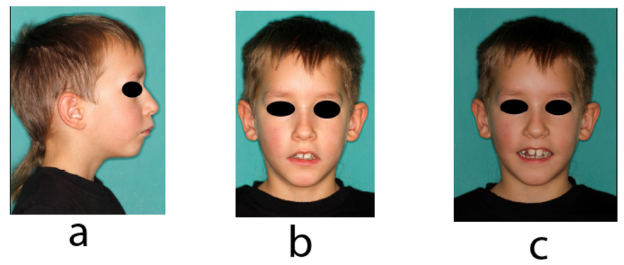 The Use of Magnetic Resonance Imaging in Diagnostics of Radix Paramolaris: A Case Report