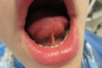 Comparative Analysis of Methods for Surgical Treatment of Ankyloglossia: A Review Article