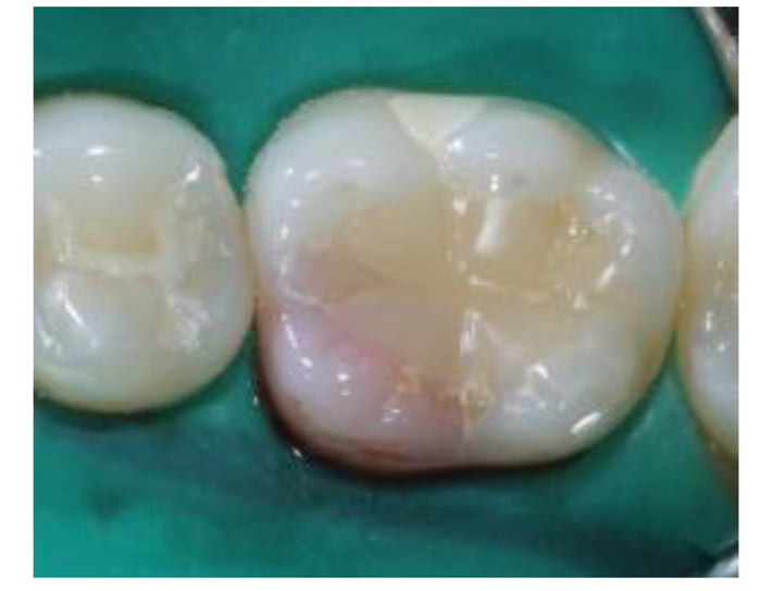 Conservative Restorative Management of External Cervical Tooth Resorption: A Case Report