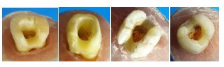 Fracture Resistance and Failure Mode of Endocrown Restorations with Different Remaining Walls and Finish Lines