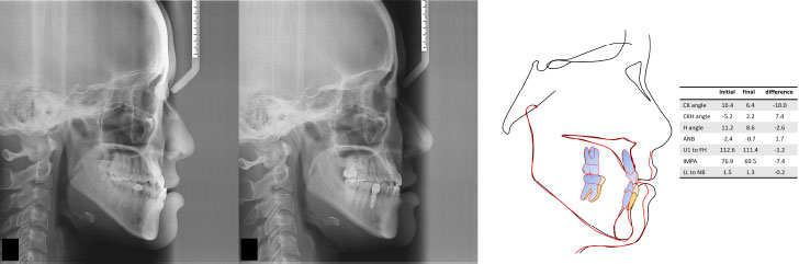 The Lower Lip Profile Change During Total Distalization of the
Mandibular Dentition