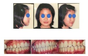 Management of Impacted Mandibular Second Molar: A Case Report