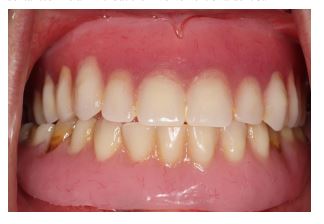 Characterization of Dentures for a Natural Esthetic Result: A Case Report