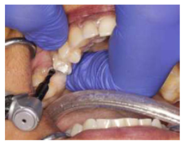 Trans-Sinus Implant using TTPHIL-ALL-TILT
Technique as an alternative to Sinus lifts: A Technical Description and Case Series