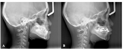 Profile Changes in Class III Malocclusion using Protraction Facemask in Indonesian Young Patients (Cephalometric Study)