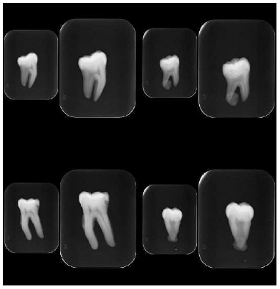 Degree of Concordance Between Cone Beam Computerized Tomography (Cbct) And 2d Digital Radiography System Used for Caries Diagnosis: An Observational Study