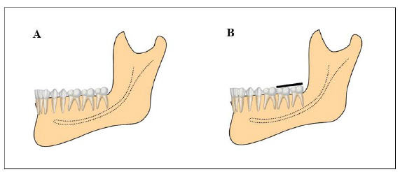 Effect of Different Desensitizing Protocols on Pulp Inflammatory Responses in Whitened Teeth: A Randomized Clinical Trial