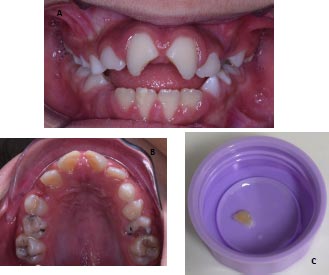 A Case Report of Different Management Protocols for Uncomplicated Crown Fracture in Young Permanent Teeth; Fragment Reattachment Resin Restoration