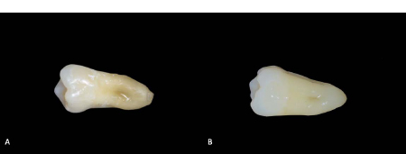 Visual and Instrumental Color Match Evaluation of Single Shade Composites before and after Bleaching Procedures: A Pilot Study
