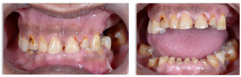 Systematic Management of Severe Anterior Tooth Surface Loss using Provisional Onlay and Permanent Overlay Removable Prostheses: A Case Report