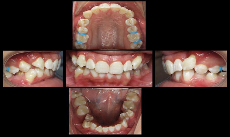 Surgical and Orthodontic Management of Multiple Supernumerary Teeth Associated with Impacted Permanent Teeth: A Case Report