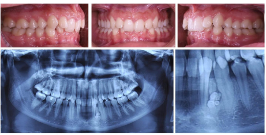 Compound Odontoma in Canine Region and its Radiological Evidence: Case Reports