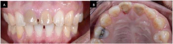 Management of Trauma-induced External Root Cervical Resorption and Discolouration of the Maxillary Central Incisors: A Case Report with a Four-year Follow-up