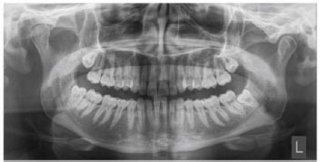 Assessment of Panoramic Radiograph Errors: An Evaluation of Patient Preparation and Positioning Quality at Soelastri Dental and Oral Hospital