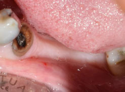 Evaluation of Soft Tissue Changes Following Platelet-rich Fibrin in Immediate Implantation of Posterior Teeth: A Randomized Clinical Trial