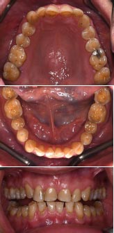 Digital Full-mouth Rehabilitation for Complex Cases Involving Severe Deep Overbite and Worn Dentition: A Case Report