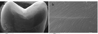 Cuspal Deflection and Marginal Integrity of Class II Cavities Restored with Bulk-fill Resin Composites