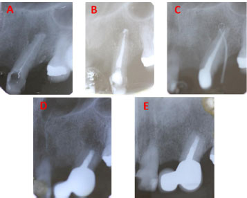 The Biomineralization Conundrum of Calcified Extraradicular Deposits on the Apical Root Surface of Teeth: A Case Report
