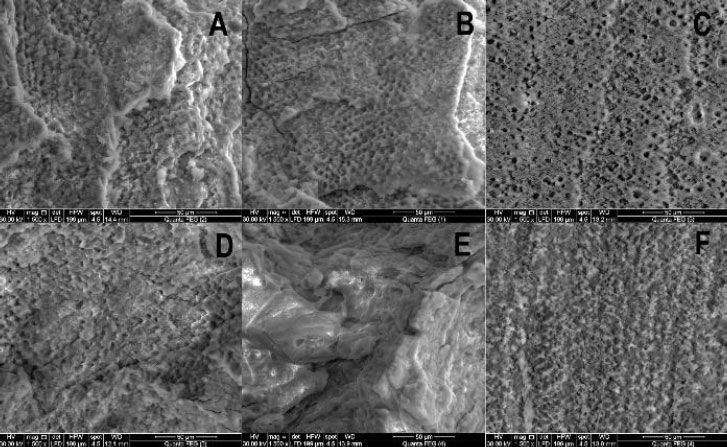 Surface Roughness of Er, Cr: YSGG Laser Etched Enamel Compared to Phosphoric Acid Etched Ename: An Study