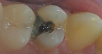 Uncommon Restoration on Nonvital Premolar with Porcelain Inlay: A Case Report with Five-year Follow-up