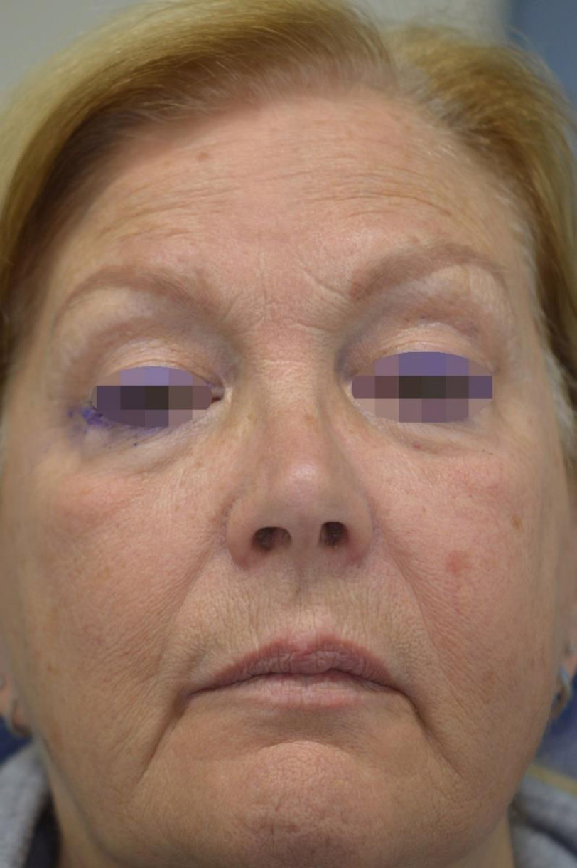 Buccal Space Collection of Ozonized Sunflower Oil Following Off-Label Injection: A Case Report