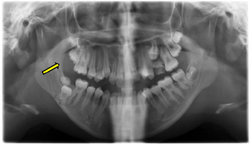 Complex Odontoma Hampering the Eruption of a Mandibular Second Molar: A Case Report
